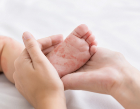 Epidemia odry zagraa niemowltom i maym dzieciom? Jest bardziej zaraliwa ni COVID-19