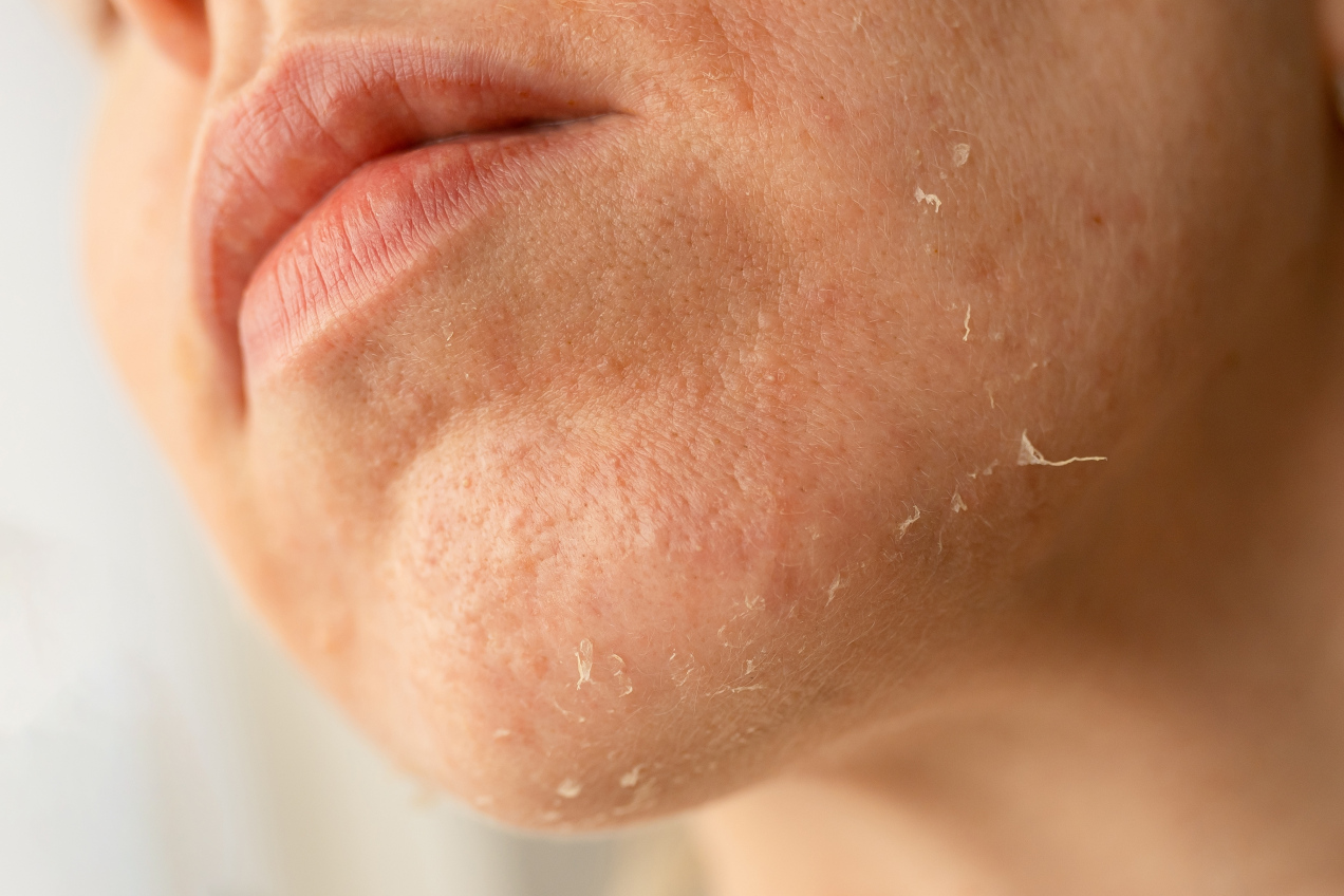 Szara i zmęczona cera? Dermatolodzy wskazują jeden błąd