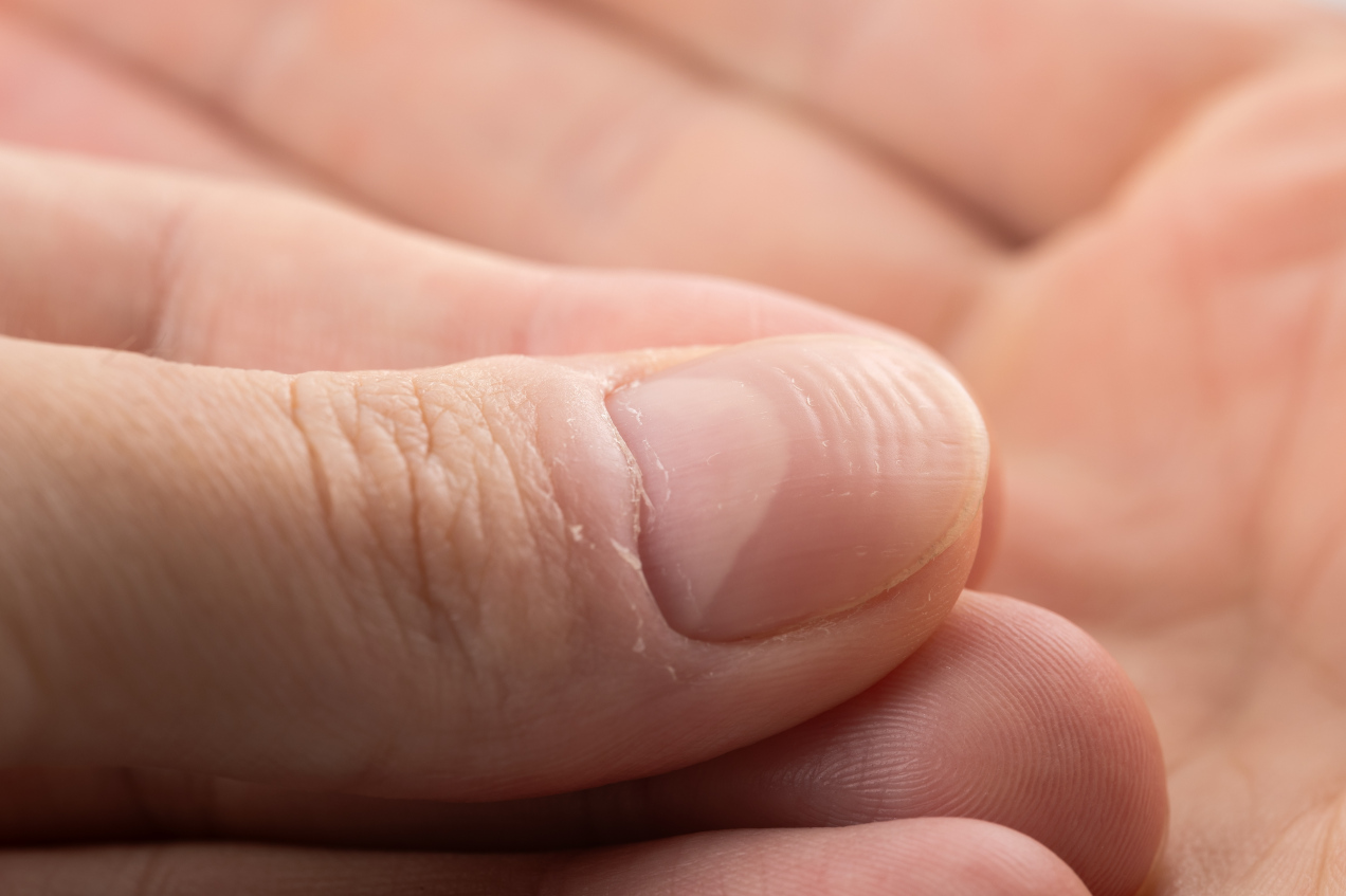 Eksperci mówią wprost, kiedy linie na paznokciach są sygnałem ostrzegawczym