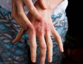 Atopowe zapalenie skóry coraz większym zagrożeniem dla nastolatków. Czym spowodowane jest to schorzenie?