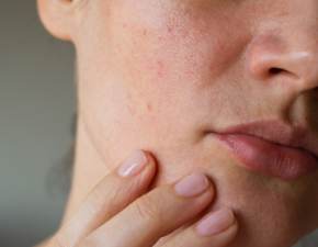 Sucha skóra: czego może być objawem? Co może wysuszać skórę?