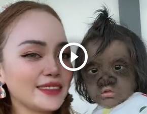 Tiktokerka opublikowaa nagranie z dziewczynk z syndromem wilkoaka. Miaa wany powd WIDEO 