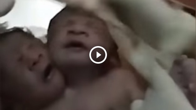 RMF Extra: Dwugłowe dziecko urodziło się w Indiach