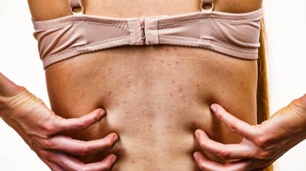 Rubinki na skórze. Skąd się biorą czerwone kropki..