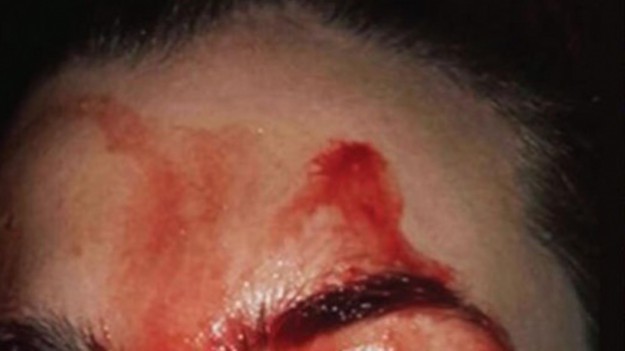 RMF Extra: Nietypowa przypadłość. 21-latka poci się krwią!