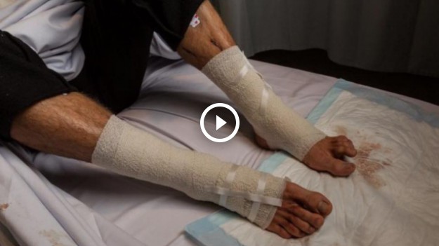 RMF Extra: Wszy morskie zjadały nogi Australijczykowi. Pasożyty grasują też w Bałtyku!