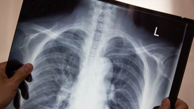 RMF Extra: 7-latka ciągle kaszlała. Niewiarygodne, co lekarze znaleźli w jej płucach [FOTO]