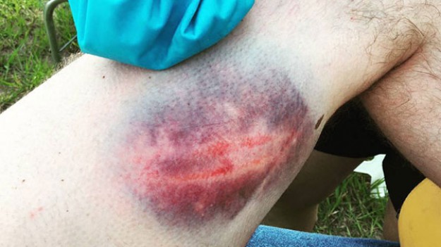 RMF Extra: Rajd Dakar 2017: Rafał Sonik "zarobił potężny krwiak na nodze..."