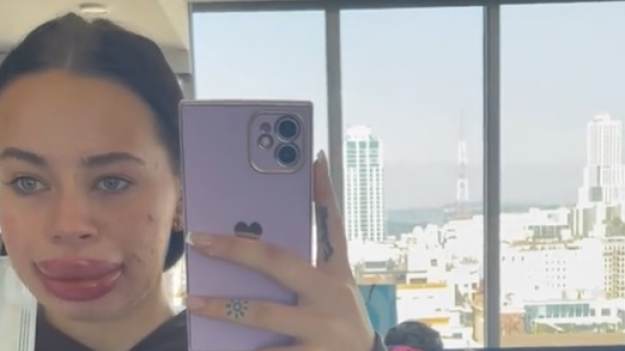 RMF Extra: Wygrała powiększenie ust za darmo. Oszpeciła sobie twarz: "Tragedia" [WIDEO] 