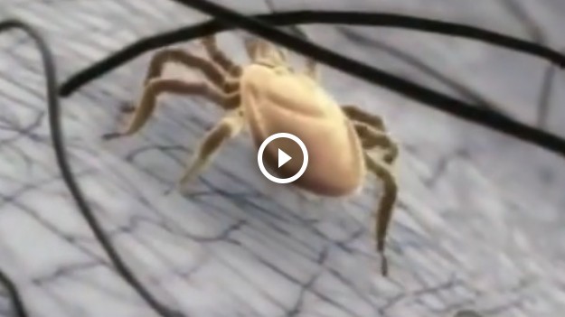 RMF Extra: Uwaga na kleszcze! Ich ukąszenie może być naprawdę groźne!