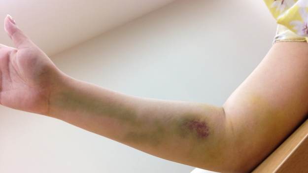 RMF Extra: Ciało nagle stało się sino-niebieskie i przeszył ją ból. Teraz ostrzega innych przed gorączką Q [WIDEO]