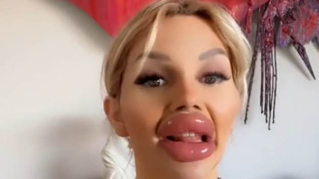 RMF Extra: Przeszła tyle operacji, że nie może normalnie jeść. "Jestem bardziej ustami niż człowiekiem" [WIDEO] 