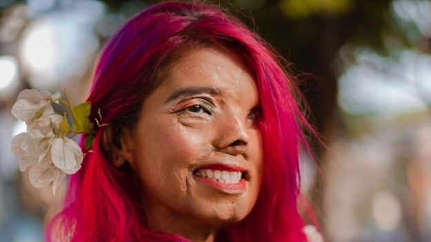 RMF Extra: Ojciec oblał ją kwasem kiedy miała 2 miesiące. Teraz Anmol Rodriguez jest modelką!