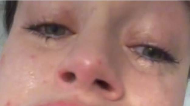 RMF Extra: Jej usta po zabiegu powiększania prawie eksplodowały. Ich wygląd szokuje. "Wyglądam przerażająco" [WIDEO]