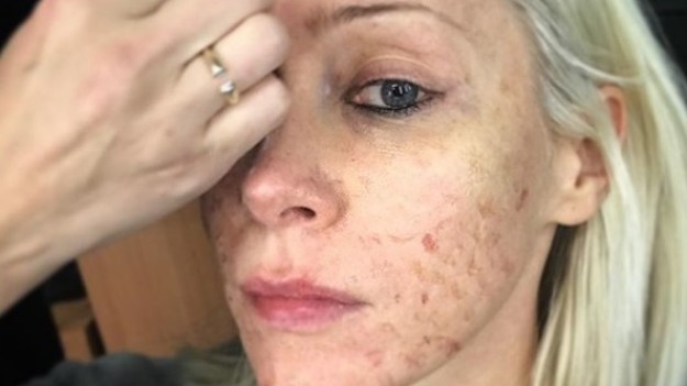 RMF Extra: Katarzyna Warnke z podbitym okiem! "Spuchnięta Anka wróciła"