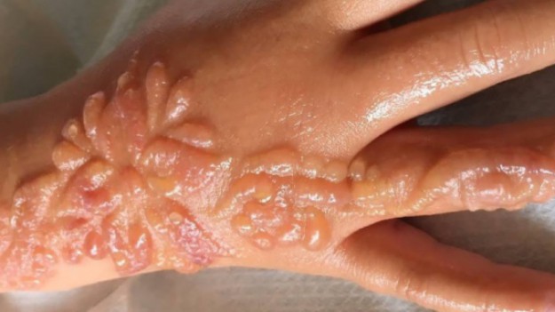 RMF Extra: To może stać się po zrobieniu tatuażu z henny. Blizny pozostają na całe życie