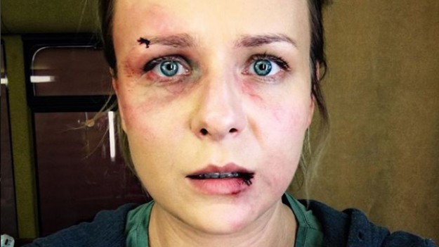 RMF Extra: Aneta Zając ze zmasakrowaną twarzą. "Gwiazdorzenie nie popłaca"